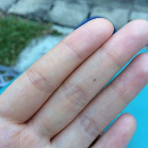mole in finger