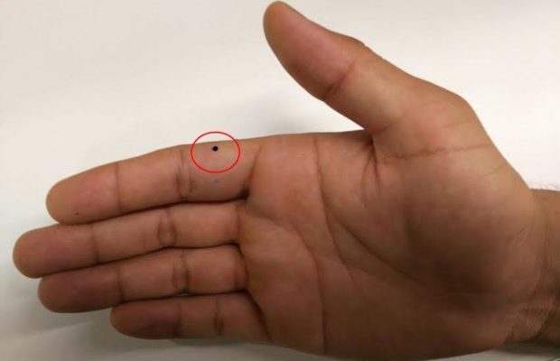 mole in finger