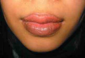lips problem