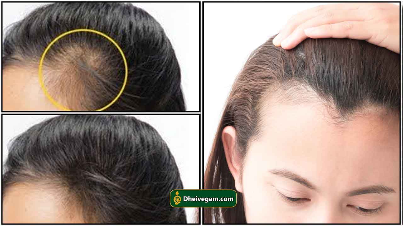 முன் நெற்றி வழுக்கை | Forehead Hair Growth Home Remedies