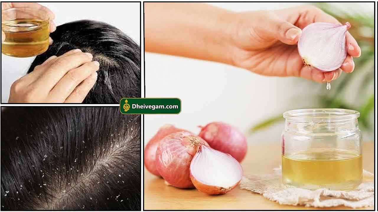 சின்ன வெங்காயம் முடி வளர | Small onion for hair growth in tamil