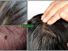 how to remove lice from hair permanently at home Archives - Dheivegam