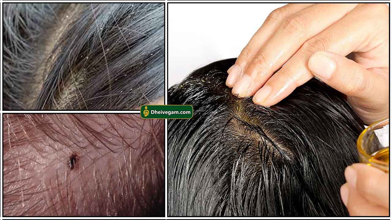 how to remove lice from hair permanently at home Archives - Dheivegam