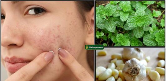 Pimples Vara Karanam In Tamil Archives Dheivegam