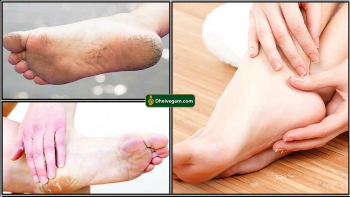 foot crack