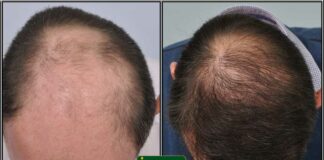 bald hair treatment