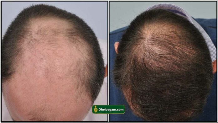 bald hair treatment