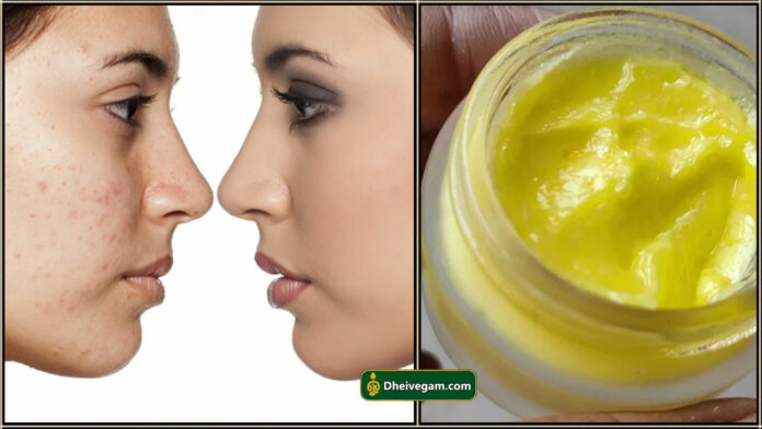 pimple free cream