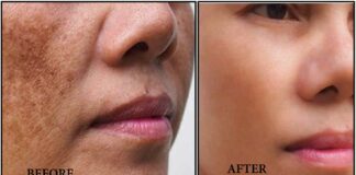 முகத்தில் இருக்கும் மங்கு மறைய face