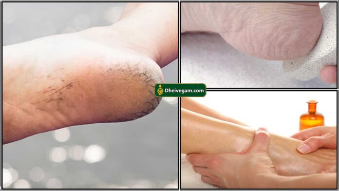 foot crack