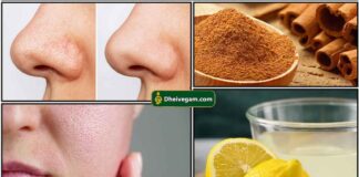 black-heads-remedy