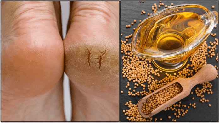 crack feet oil