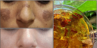 மங்கு கருந்திட்டுகள் நீங்க வழிமுறைகள். face beauty tips