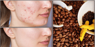 கலங்கமற்ற முகத்தை பெற pimples face