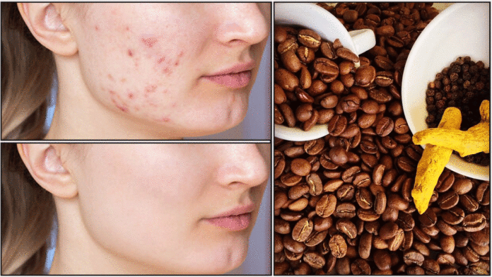 pimples face
