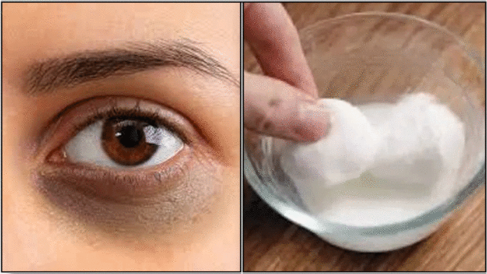 dark circles