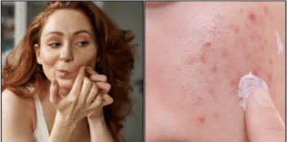 pimple