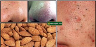 badam-blackheads